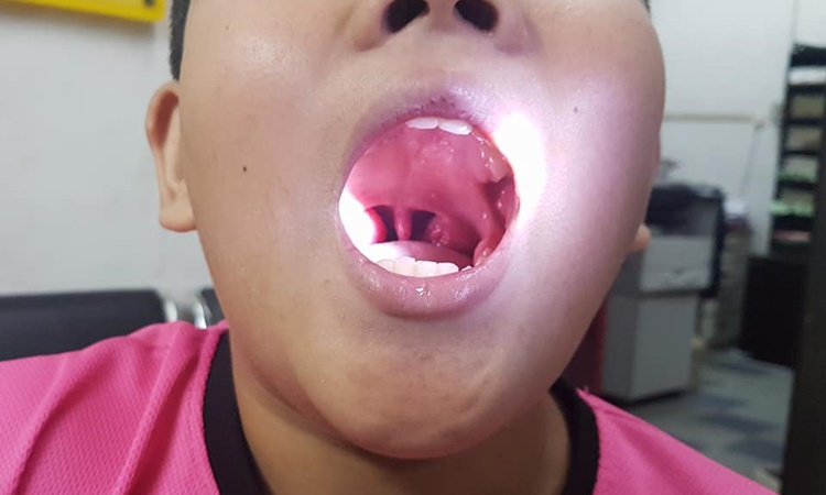 Doktor Dedah Makan Aiskrim Vanila Ubati Tonsil Bengkak 