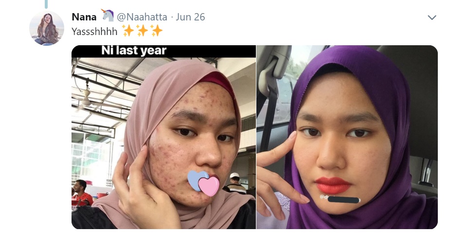 Gadis Dedah Rahsia Hilangkan Jerawat Dengan Hanya RM5