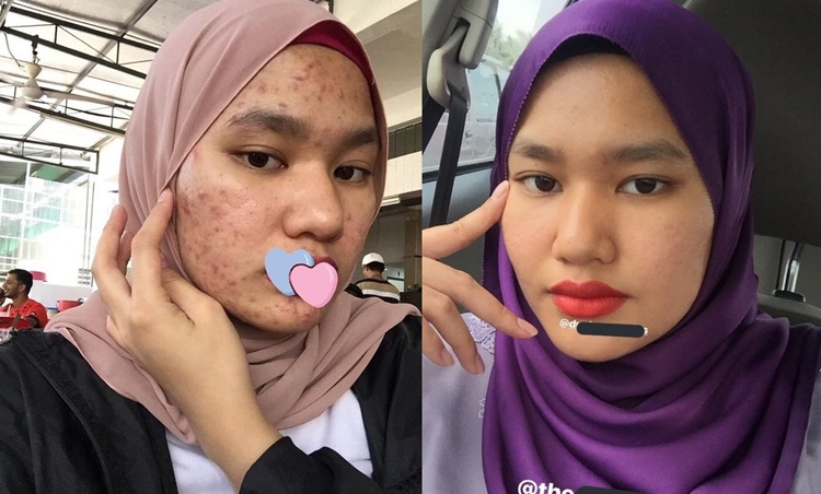 Gadis Dedah Rahsia Hilangkan Jerawat Dengan Hanya RM5